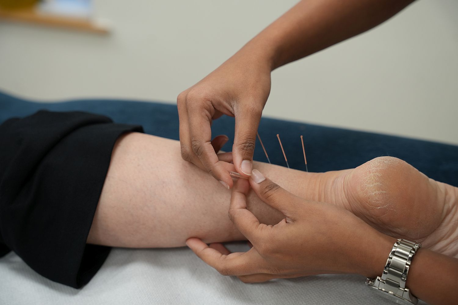 Acupuncture treatment at Xcel Health