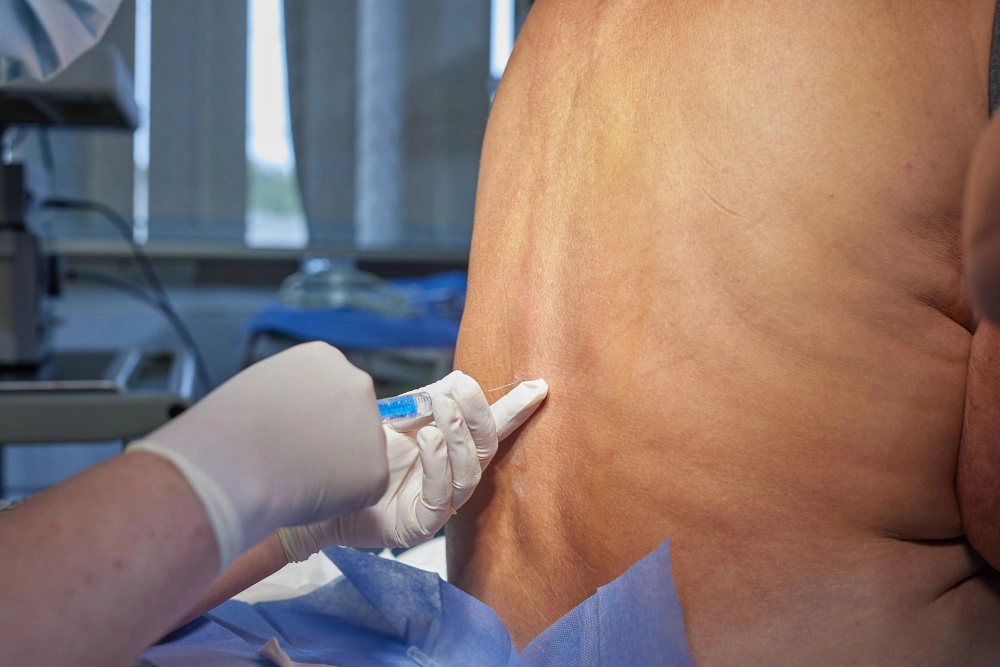 Spinal injection therapy